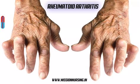 Rheumatoid arthritis >Causes, symptoms, treatment - Medical Surgical