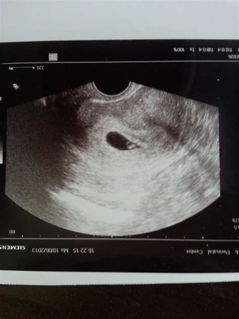 Фото УЗИ первой беременности и второй.. — 24 ответов | форум Babyblog