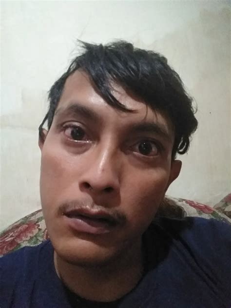 cara mengatasi muka merah dan bengkak 8