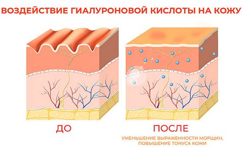 Гиалуроновая кислота