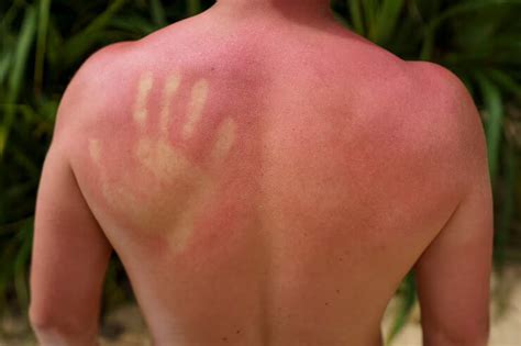 care   treating  sunburn  personal care