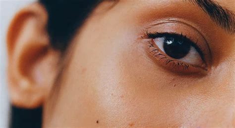 understanding dark spots   face allure laser skin  aesthetic