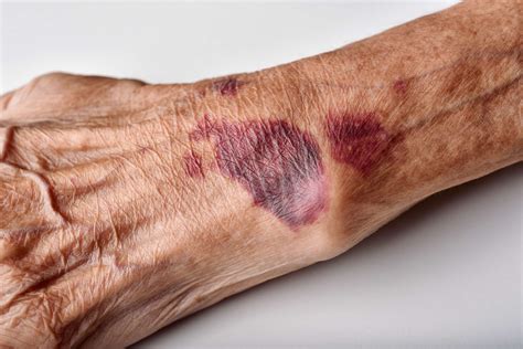 red bruises   arms  madison hales blog