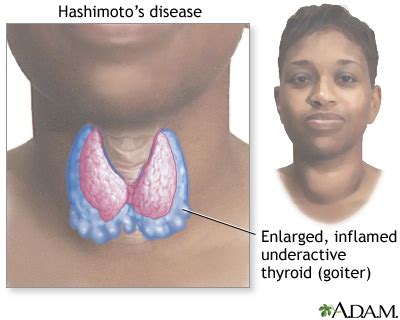 Hashimoto's disease (chronic thyroiditis): MedlinePlus Medical ...