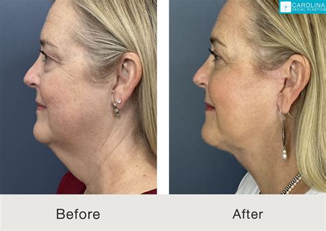 neck lift recovery day  day carolina facial plastics