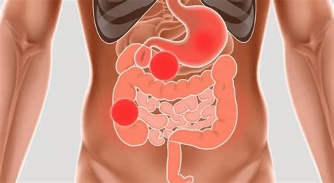 Como É A Dor No Intestino - Como saber se a dor é no estômago ou no intestino: Sintomas e localização