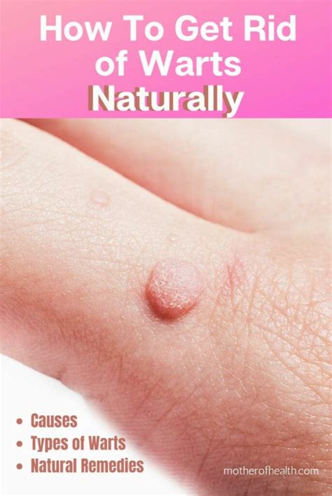 How To Get Rid of Warts Naturally | Mother Of Health
