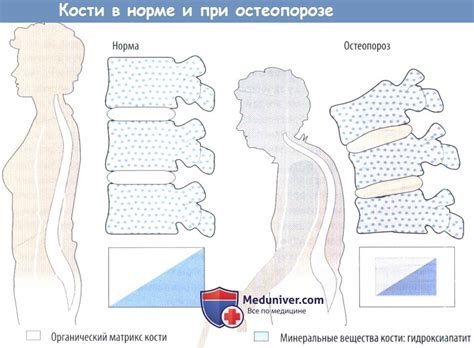 Лекарства для лечения остеопороза