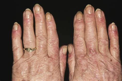 Systemic Lupus Erythematosus Signs And Symptoms Patho - vrogue.co