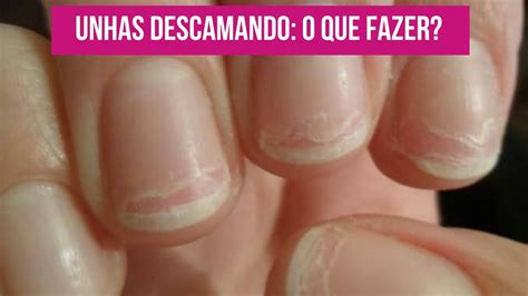 Unhas Do Pé Descamando - UNHAS DESCAMANDO: E AGORA? CAUSAS E O QUE FAZER - YouTube