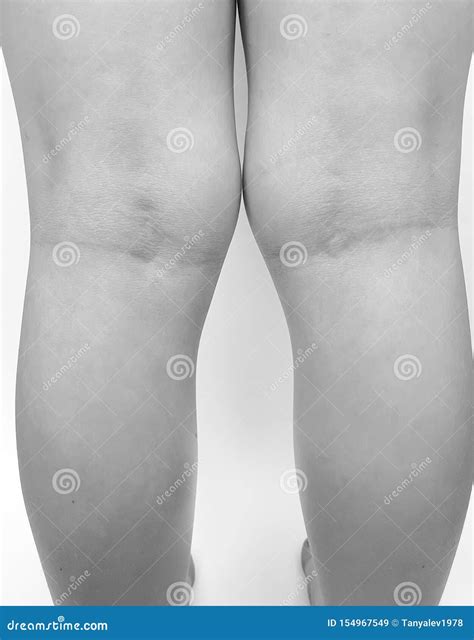 Deformation Valgus Knee Leg Child Stock Image - Image of childhood