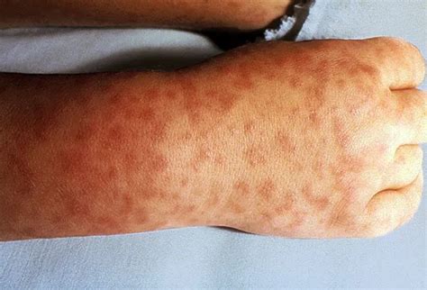 Q Fever (Coxiella burnetii) Causes, Symptoms, Diagnosis, Treatment ...