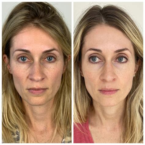 scoop  sculptra  luxe room
