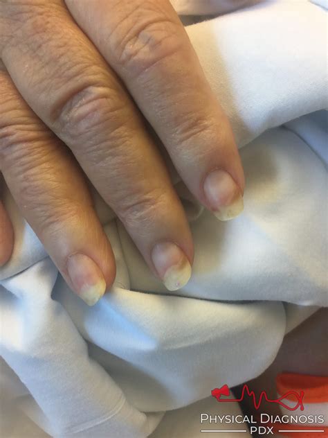 onycholysis physical diagnosis pdx