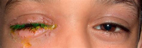 preseptal  orbital cellulitis clinical tree