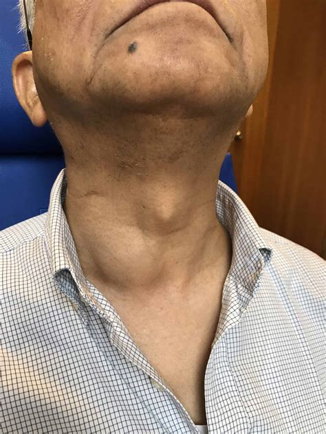 What Does A Neck Lump Look Like at Anthony Ana blog