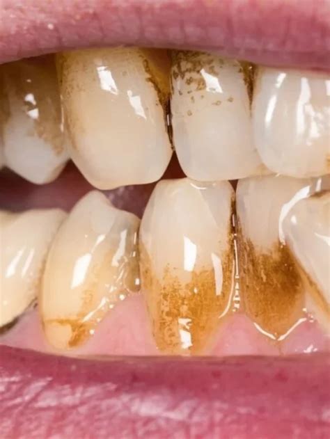 critical problems  diseases  prevent understanding   tartar