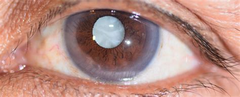 cataracts dr steve steyn