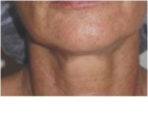 Radiofrequency Skin Tightening and firming in Essex | Woodford Medical