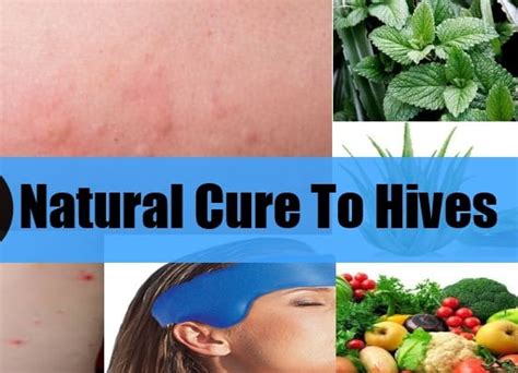 10 Best Hives Home Remedies