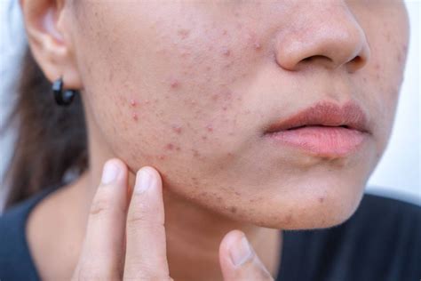 hormonal acne  triggers  treatment options iapam