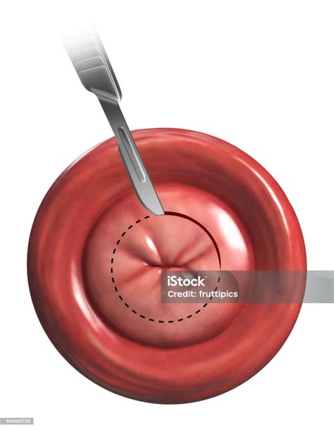 Cone Biopsy Illustration Stock Photo - Download Image Now - Anatomy ...