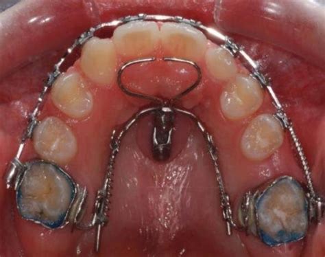 Orthodontics treatment in hypodontia. | Download Scientific Diagram