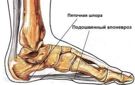 Пяточная шпора | Боль в пятке - причины, диагностика, лечение