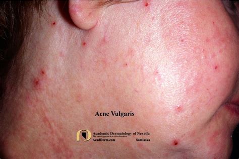 Acne Vulgaris