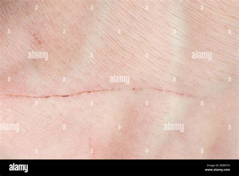 Scratch on human skin close up. Long cut on human skin Stock Photo - Alamy