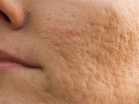 Тркалезни лузни од акни - Проблеми со лузни - 101 Skin Clinic