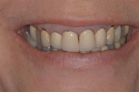 Dental Arts Before & After Photos - Dental Arts Of New Orleans