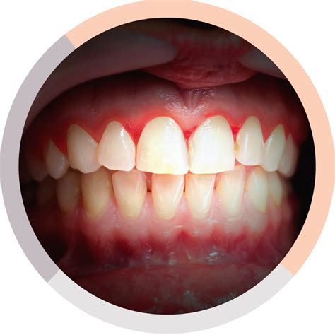 bleedingswollen gums     melbourne dentist  malvern east