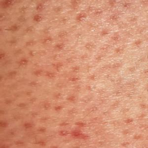 Are those Unsightly Red Bumps "Strawberry Legs"? - AMAE Med Spa ...