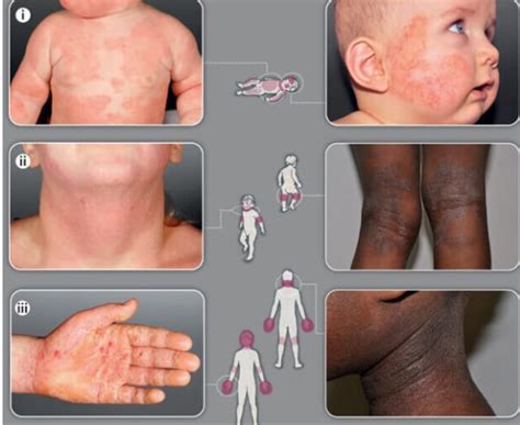 Dermatite Em Criança Tem Cura - Dermatite atópica em criança: quadro clínico e tratamento | Artmed