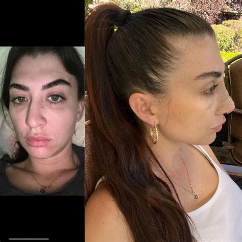 6 days after rhinoplasty with Dr Chasan. Still a lot of swelling but I