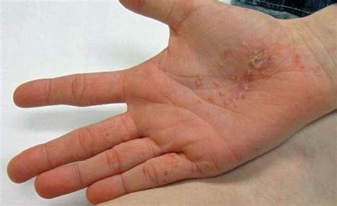 Dyshidrotic Eczema Archives - HealthNBodytips.org