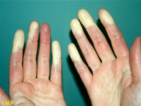 PPT - Raynaud’s Phenomenon PowerPoint Presentation, free download - ID