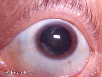 Cortical Cataract