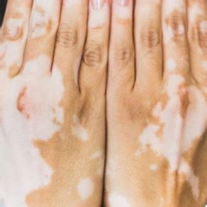 Jak dlouho trvá vitiligo?
