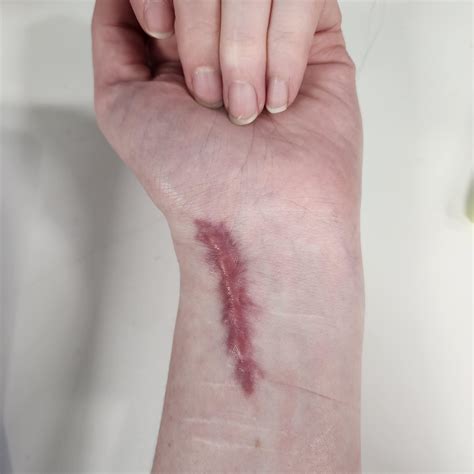 Wrist hardware removal surgury giant keloid scar : r/Keloids