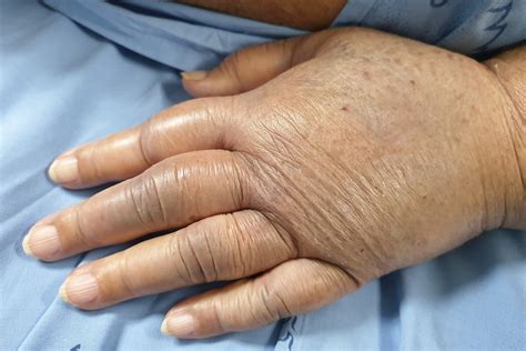 Descubra como evitar a retenção de líquido | Jornal de Brasília