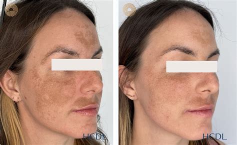 hyperpigmentation  melasma hunter coast dermatology laser