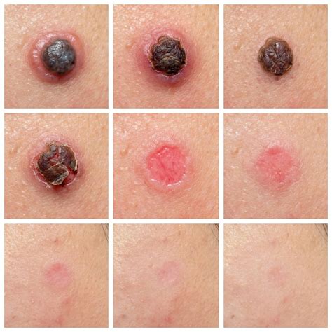 Mole Removal Healing Stages (With Pictures & Timeline)