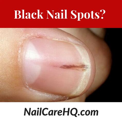 Black Spot On Toenail Cuticle Pictures - My Bios