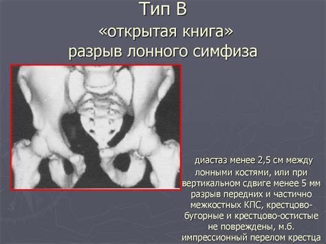 Расхождение лобковой кости при беременности: симптомы, лечение ...