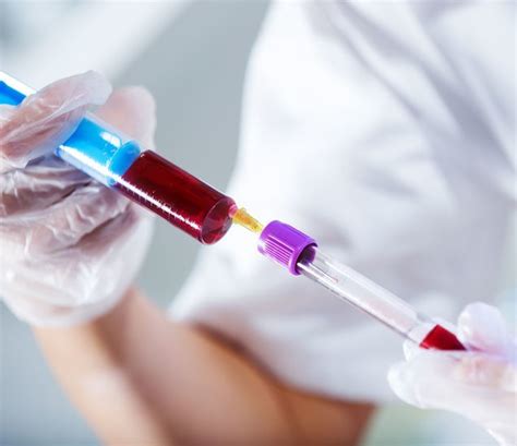 blood sodium level test purpose procedure  results
