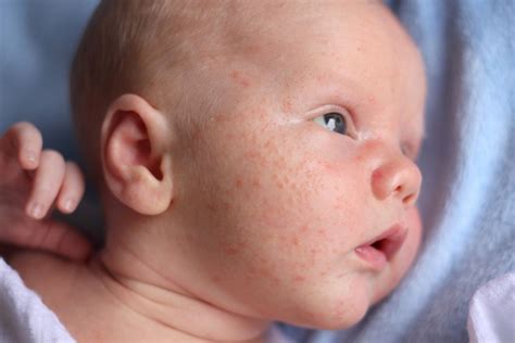 7 Steps To A Clear Complexion: How To Heal Your Baby's Acne