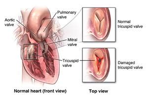 Tricuspid Valve Repair Surgery - Stanford Medicine Children's Health