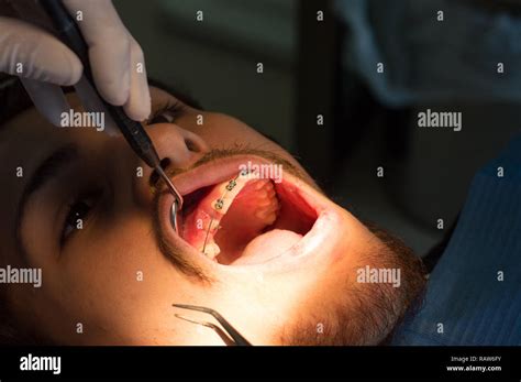 Impacted teeth hi-res stock photography and images - Alamy